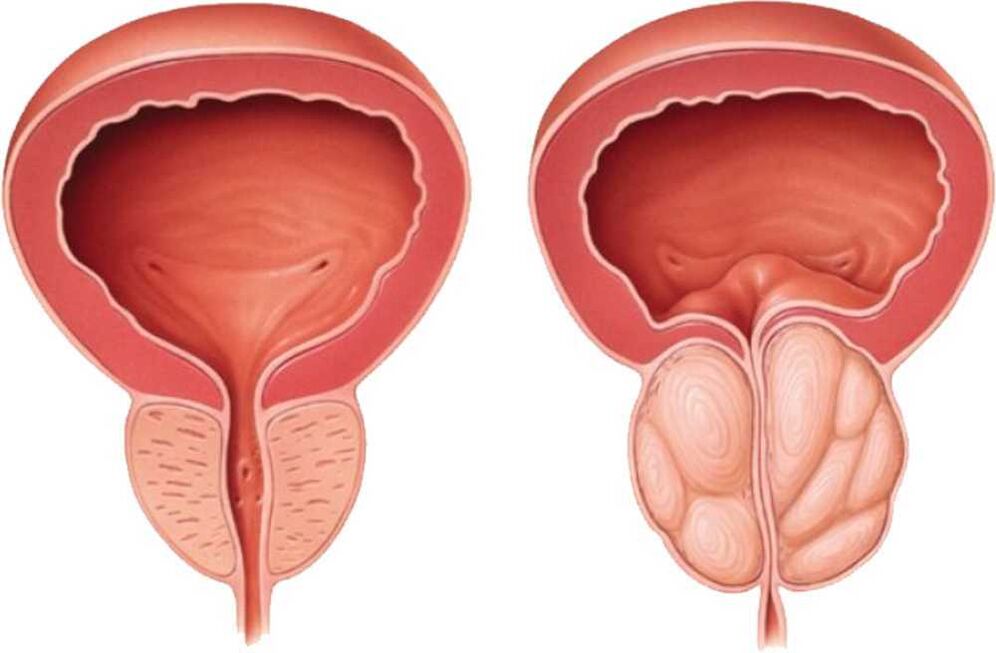 prostate pain