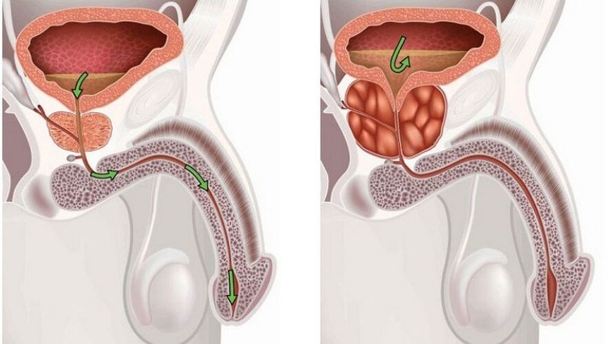 Prostatitis in male